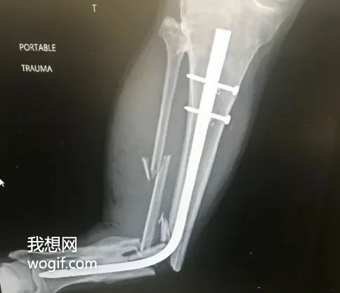康復(fù)期間，再次車(chē)禍，體內(nèi)鋼管彎了（圖）